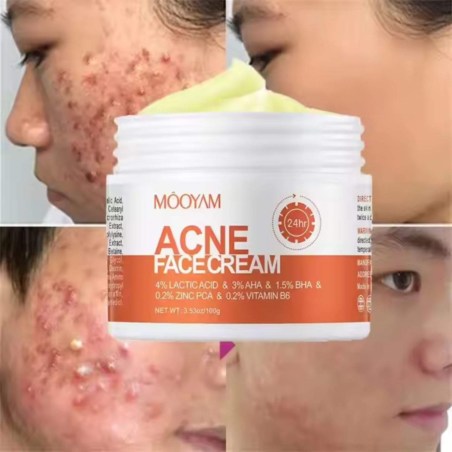 Crema Facial Anti Acné Mooyam 600022